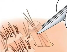 头发种植多少钱一个毛囊？相关注意事项已经收集了